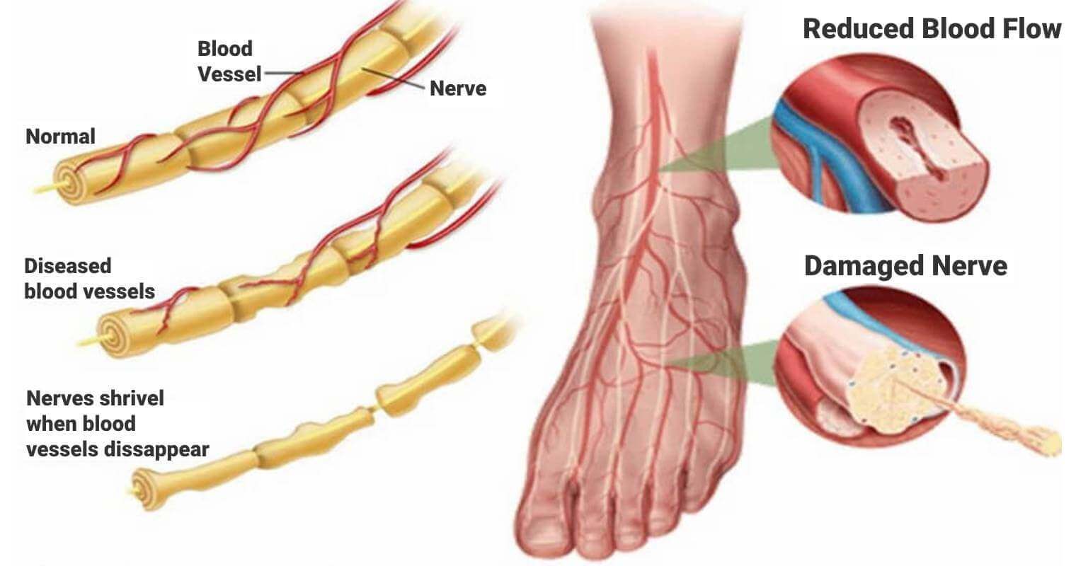 Illustration of nerve damage