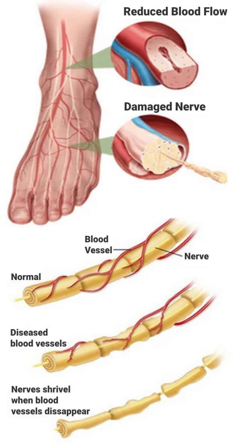 Illustration of nerve damage